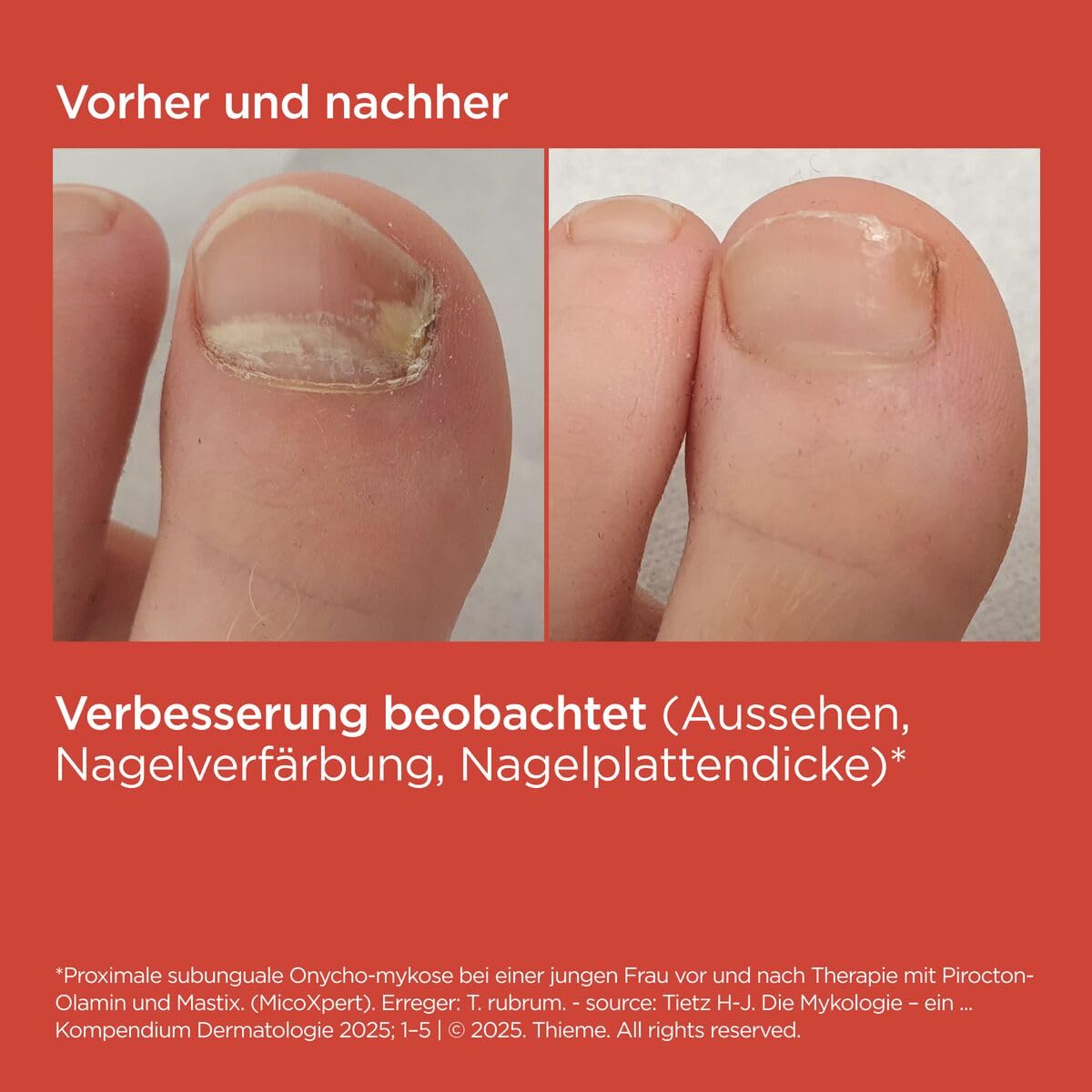 ISDIN Si-Nails MicoXpert Stift gegen Nagelpilz 4,5 ml