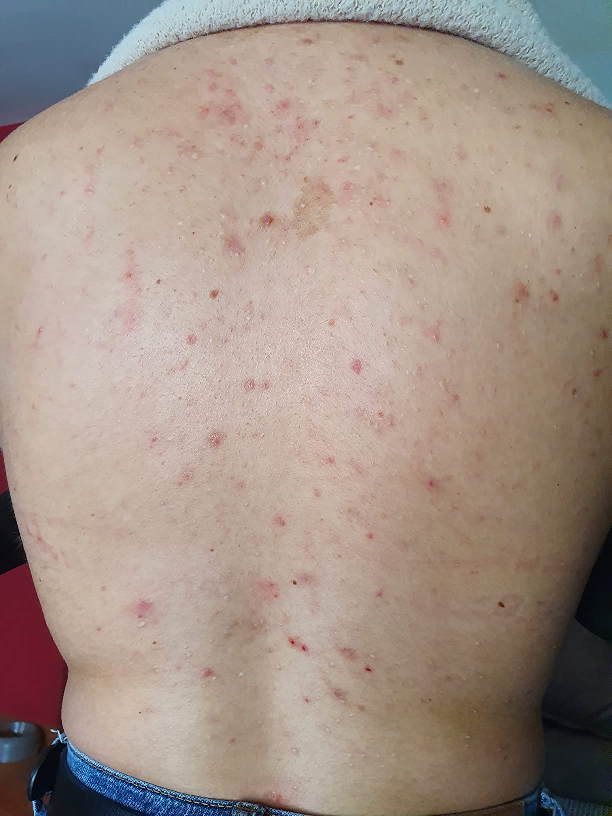 ISDIN Acniben Body Spray Körper Akne-Behandlung trocknend