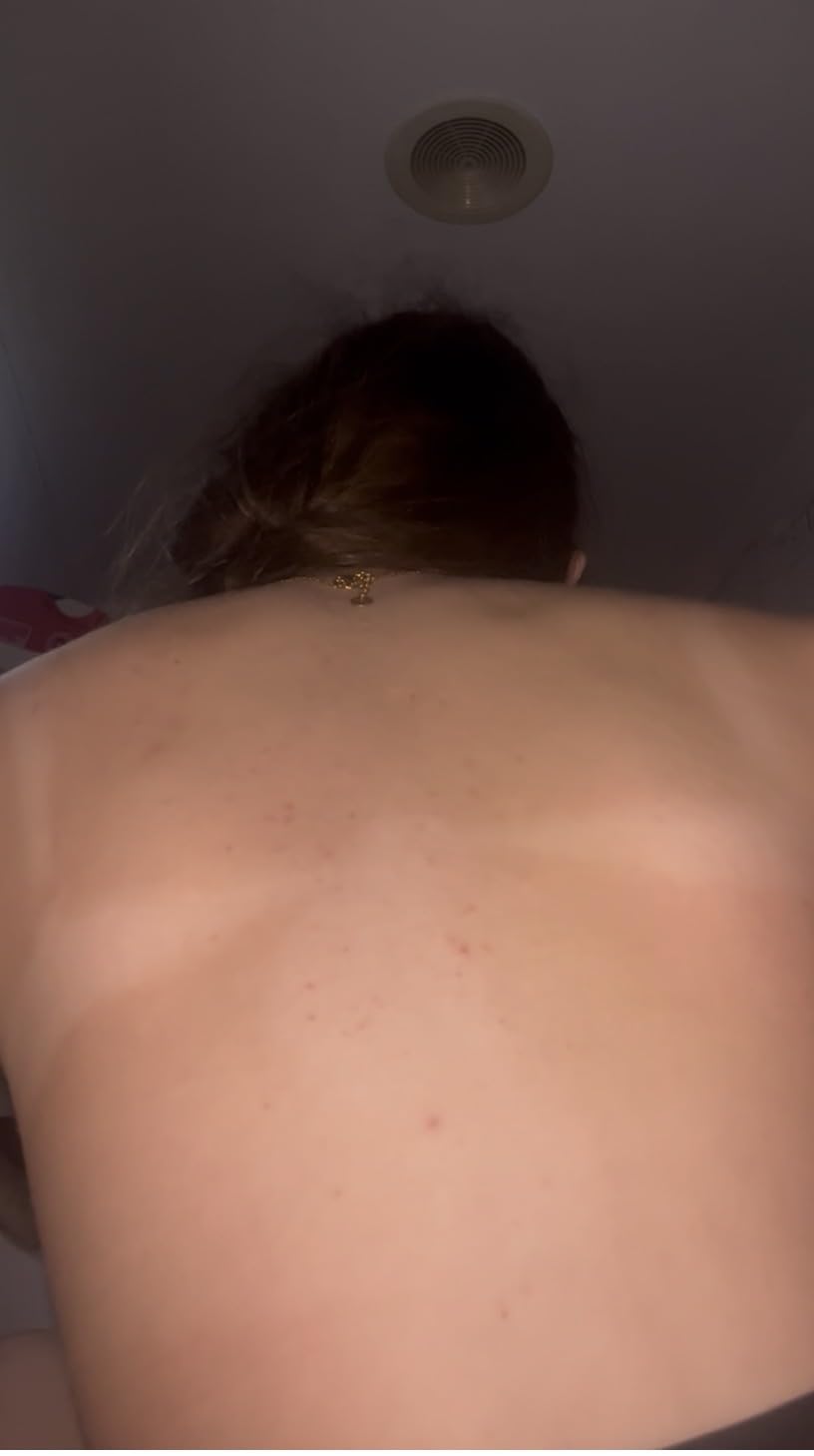 ISDIN Acniben Body Spray Körper Akne-Behandlung trocknend