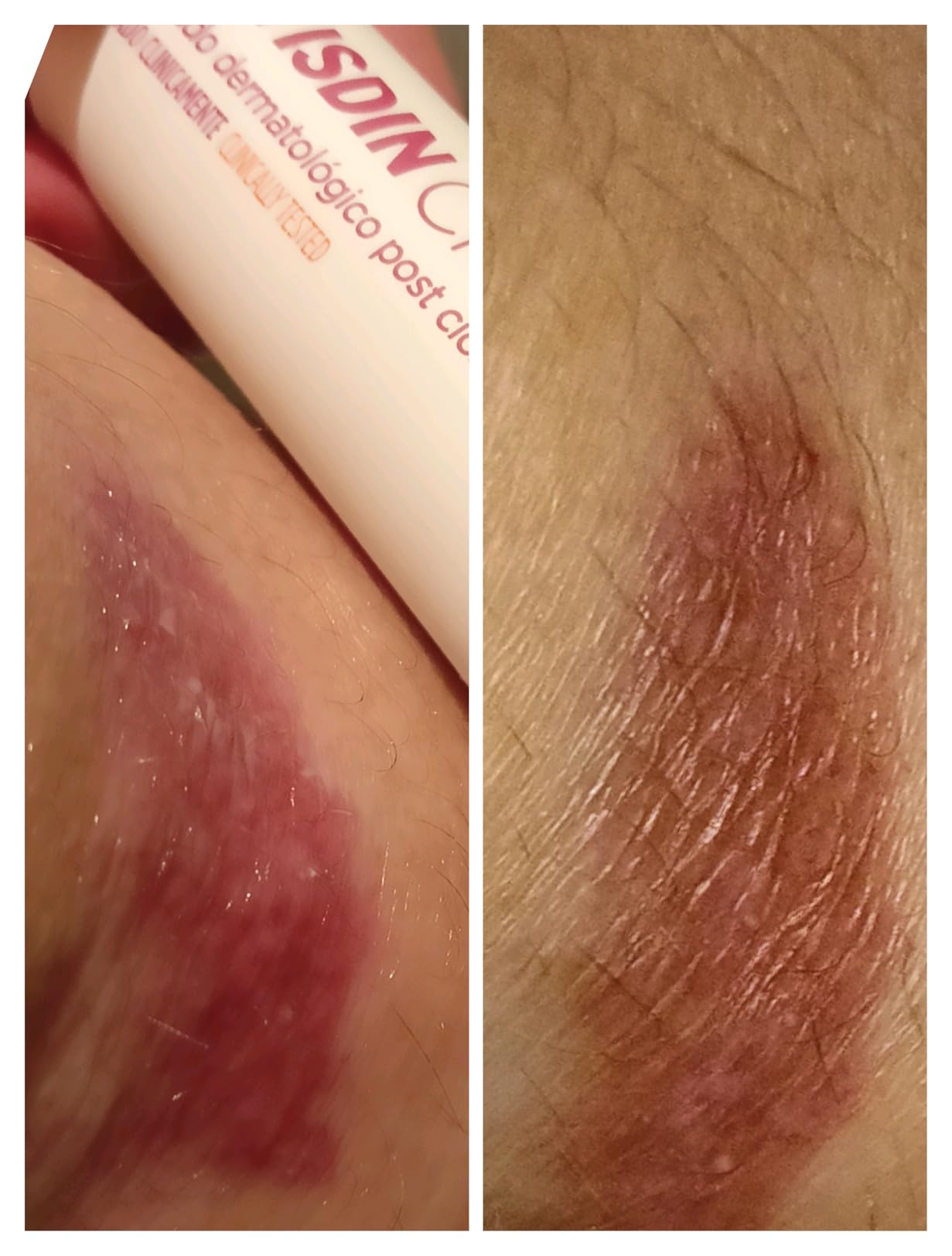 ISDIN Cicapost Narbencreme nach Narben und Reizung