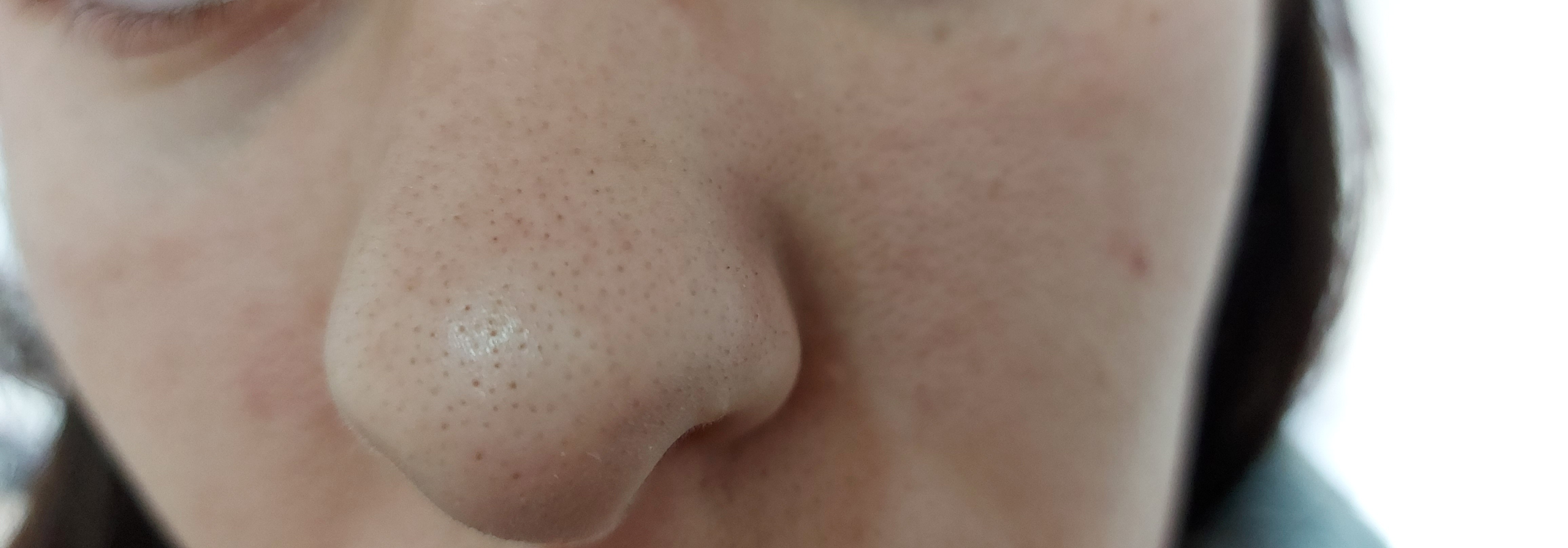 ISDIN Acniben Akne Kontroll Gel-Creme 40 ml ölfrei
