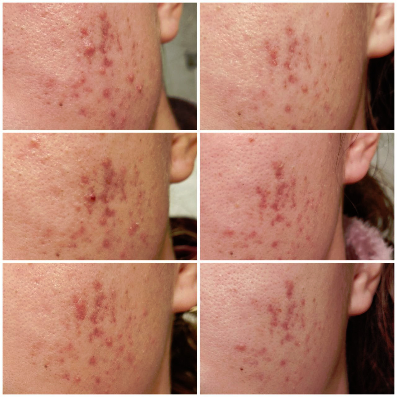 ISDIN Acniben Akne Kontroll Gel-Creme 40 ml ölfrei