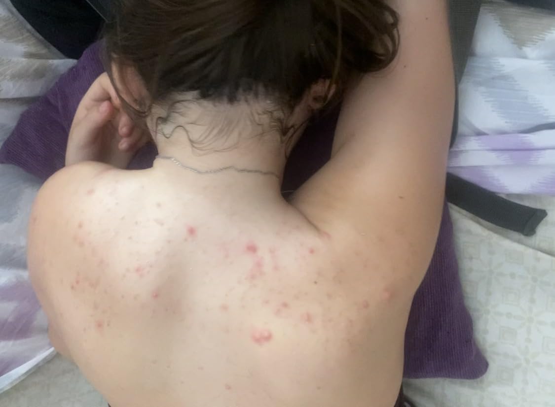 ISDIN Acniben Body Spray Körper Akne-Behandlung trocknend