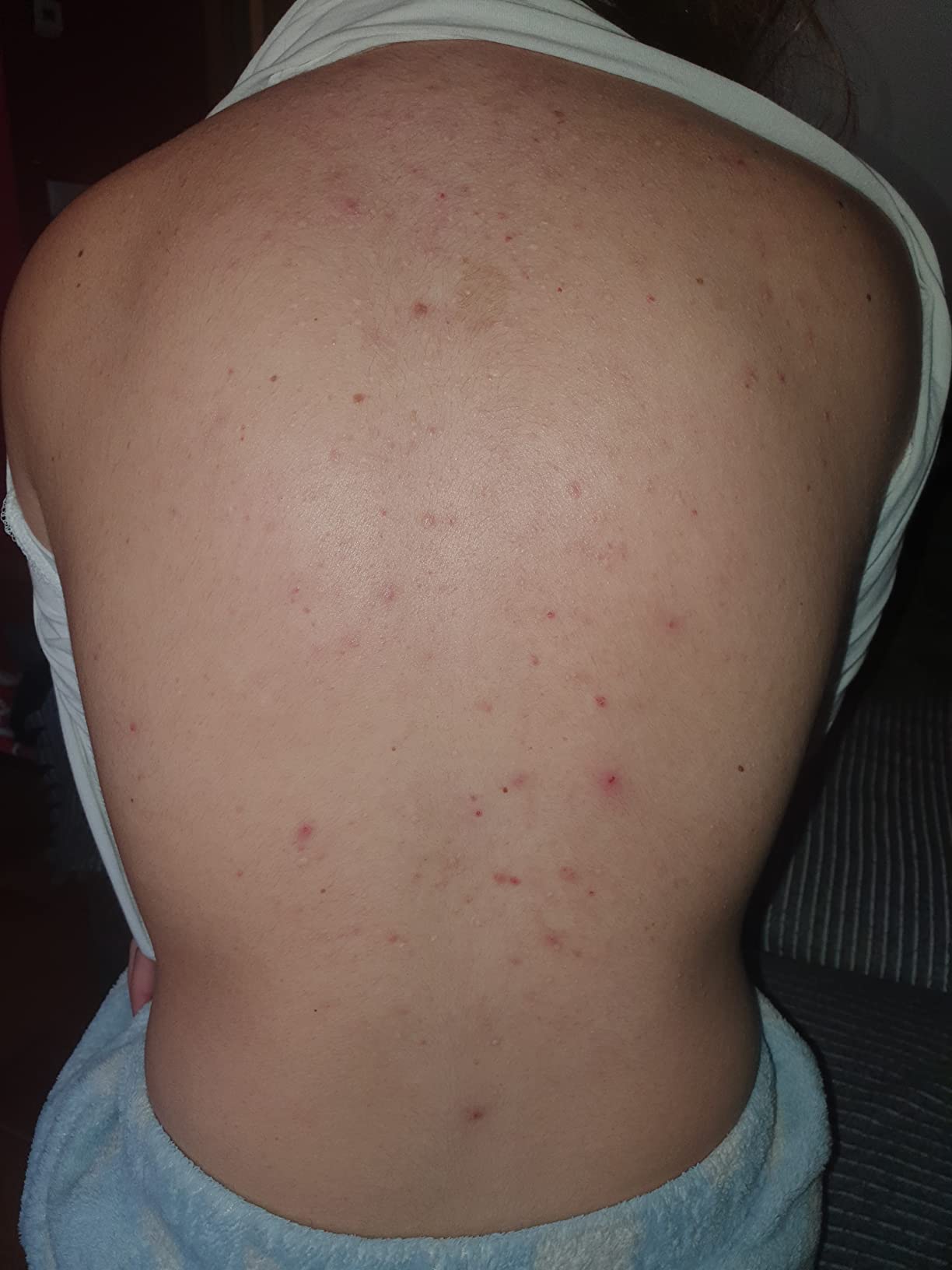 ISDIN Acniben Body Spray Körper Akne-Behandlung trocknend