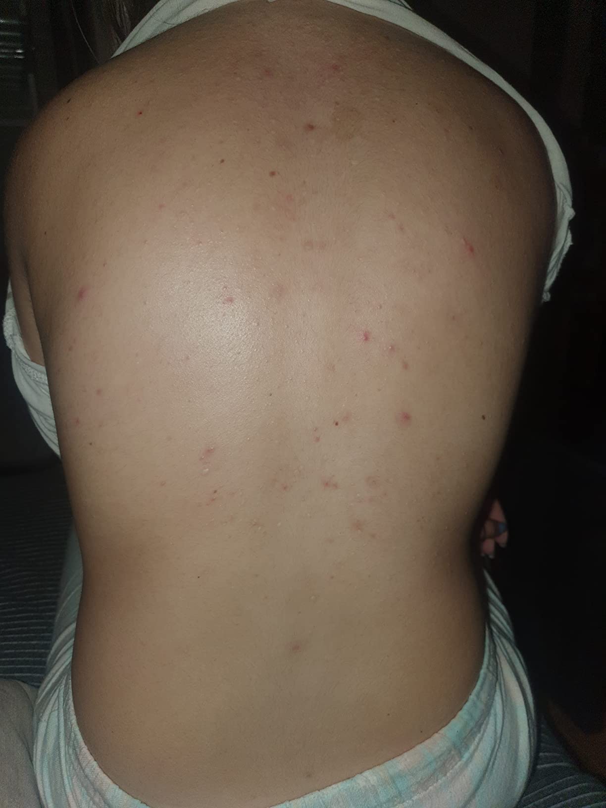 ISDIN Acniben Body Spray Körper Akne-Behandlung trocknend